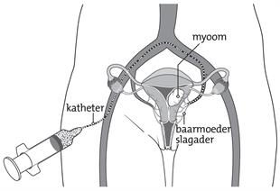 Myoomembolisatie